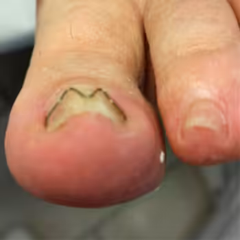 Naspan-Behandlung: Nachher