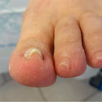 Naspan-Behandlung: Vorher