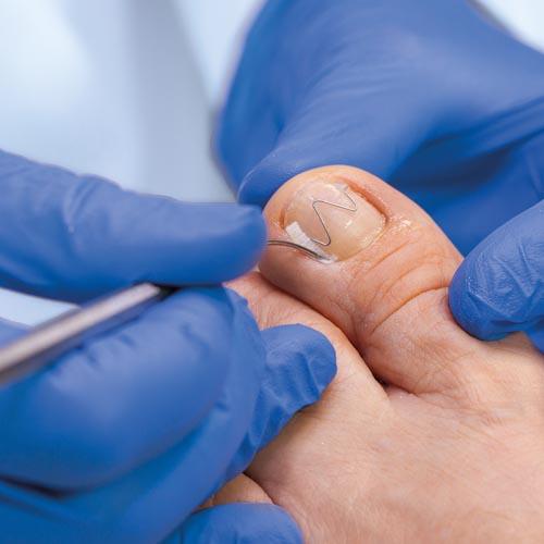 Naspan Nagel tamponieren