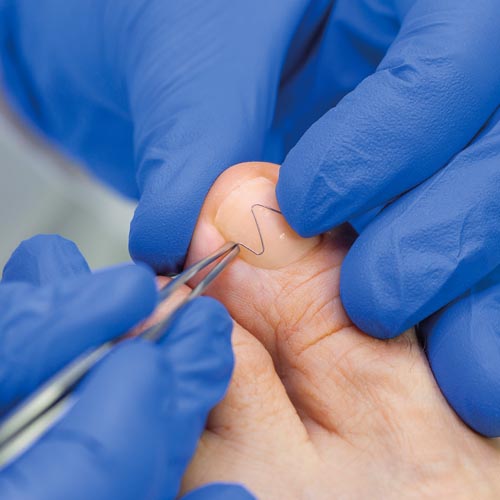 Naspan Spange aufsetzen