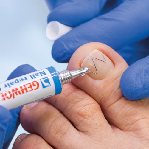 Naspan Spange fixieren